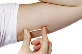 Cilt Altı İmplant Takılması